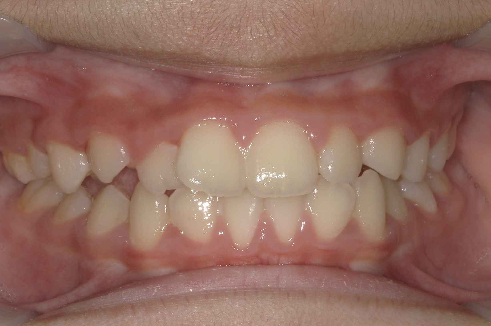 Before