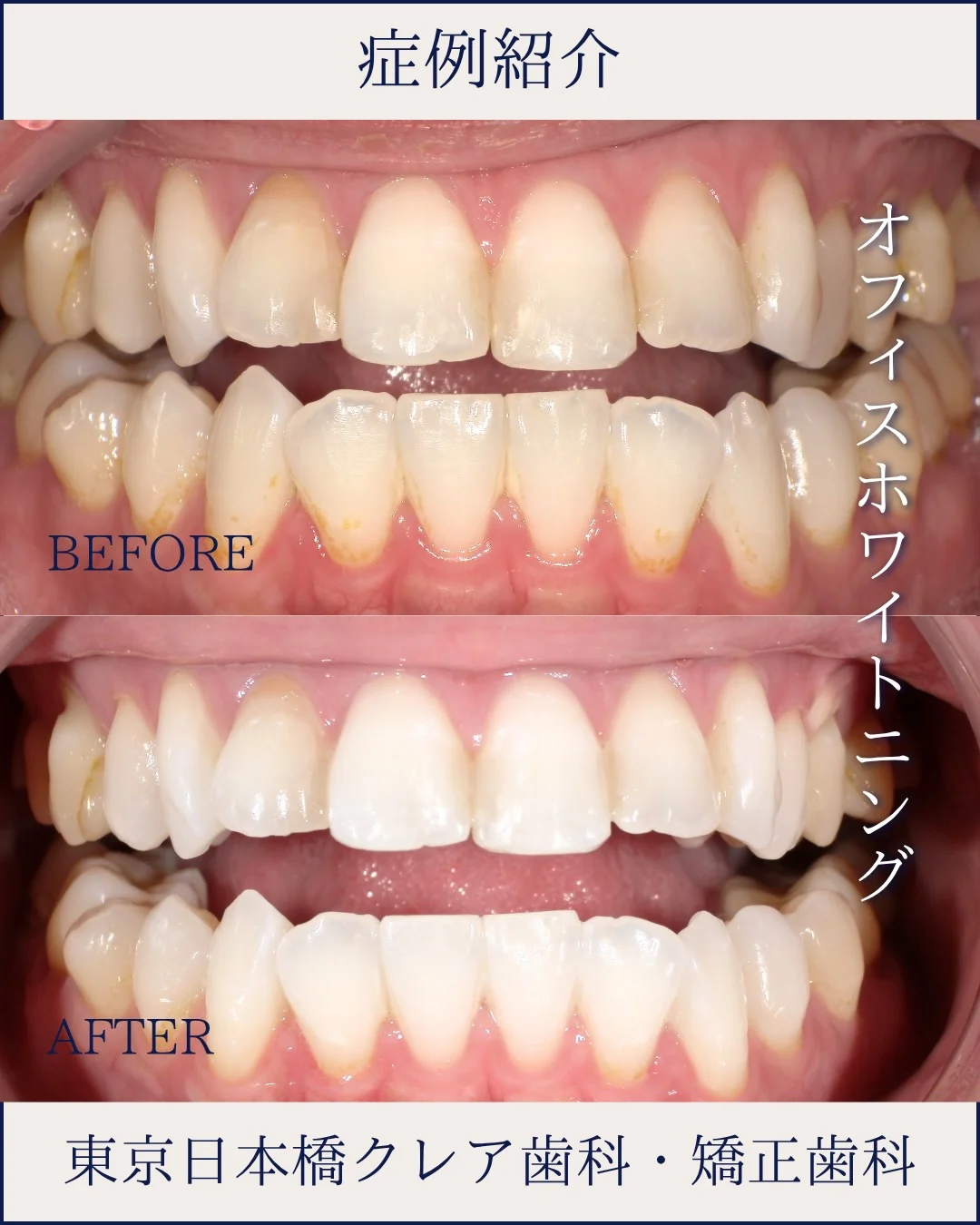 院長のInstagramの投稿。オフィスホワイトニングの症例紹介の画像