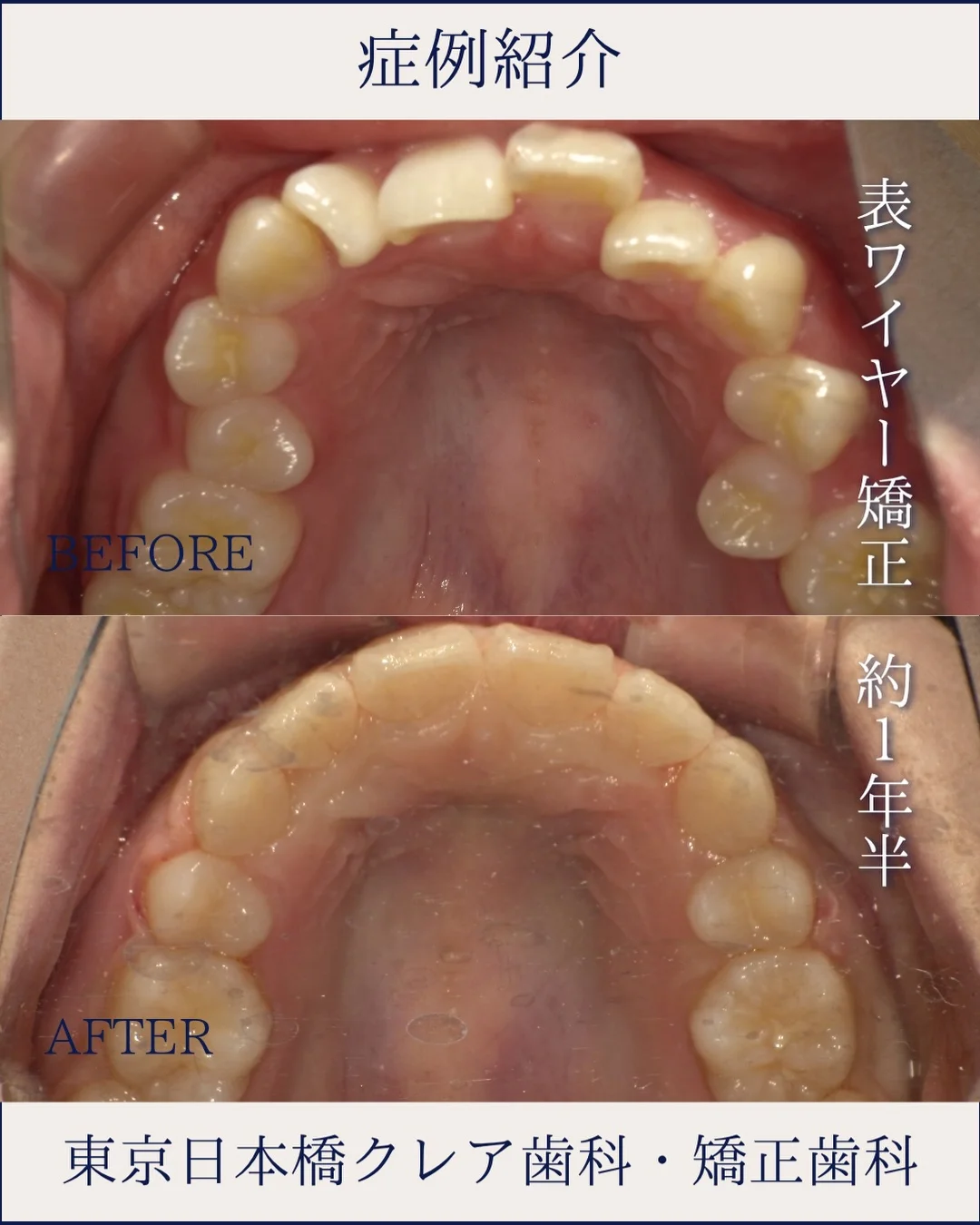 院長のInstagramの投稿。表ワイヤー矯正の症例紹介の画像