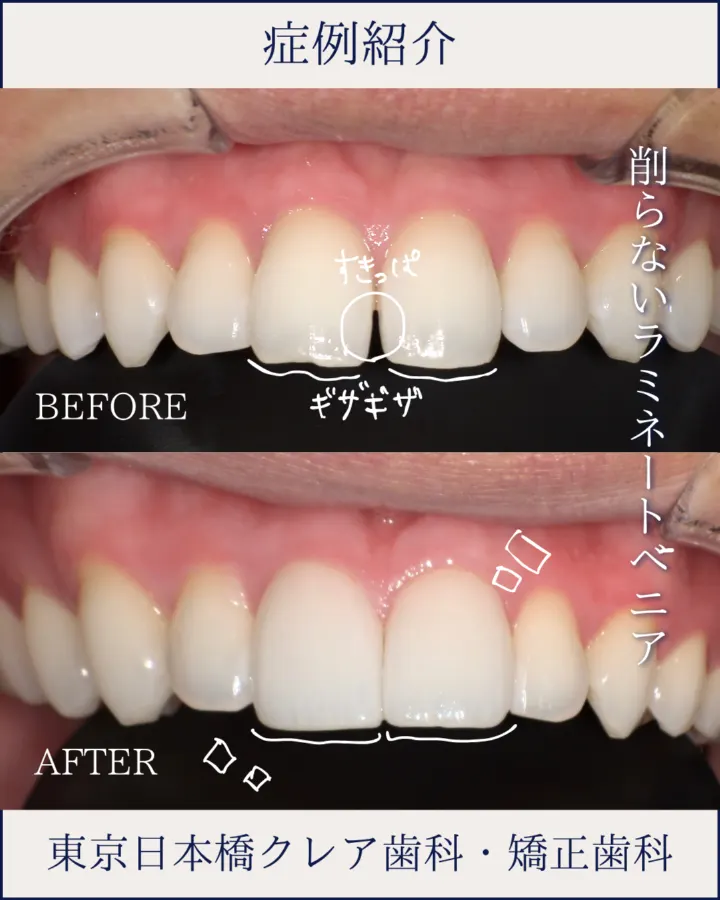 歯を削らずできる\ラミネートベニア/(治療後)